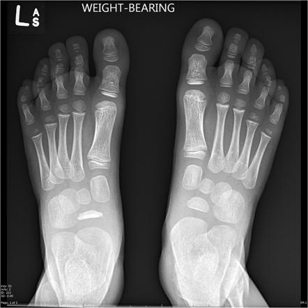 Kohler disease | Radiology Case | Radiopaedia.org