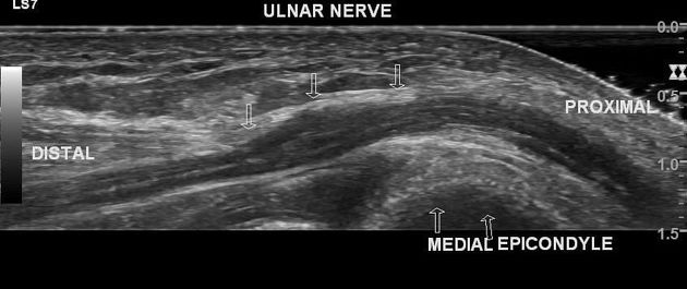 Figure, Cubital tunnel syndrome Image courtesy S Bhimji MD] - StatPearls -  NCBI Bookshelf