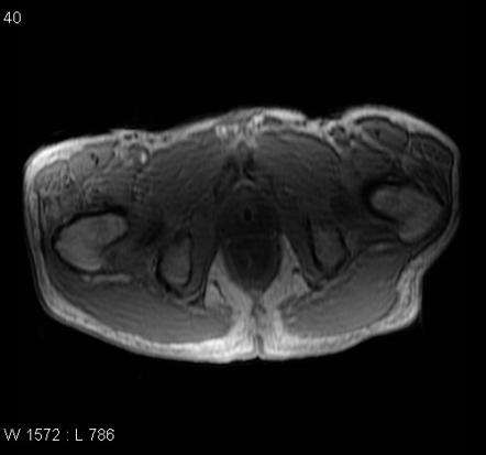 Rectal cancer - T4 invading into prostate | Image | Radiopaedia.org