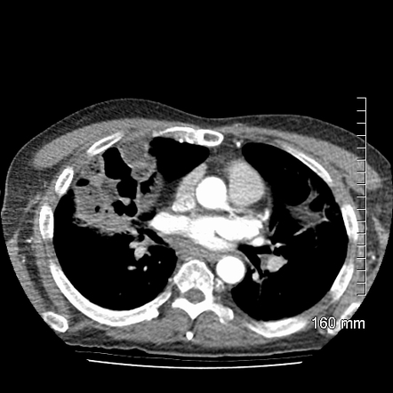 Large anterior diaphragmatic hernia | Image | Radiopaedia.org