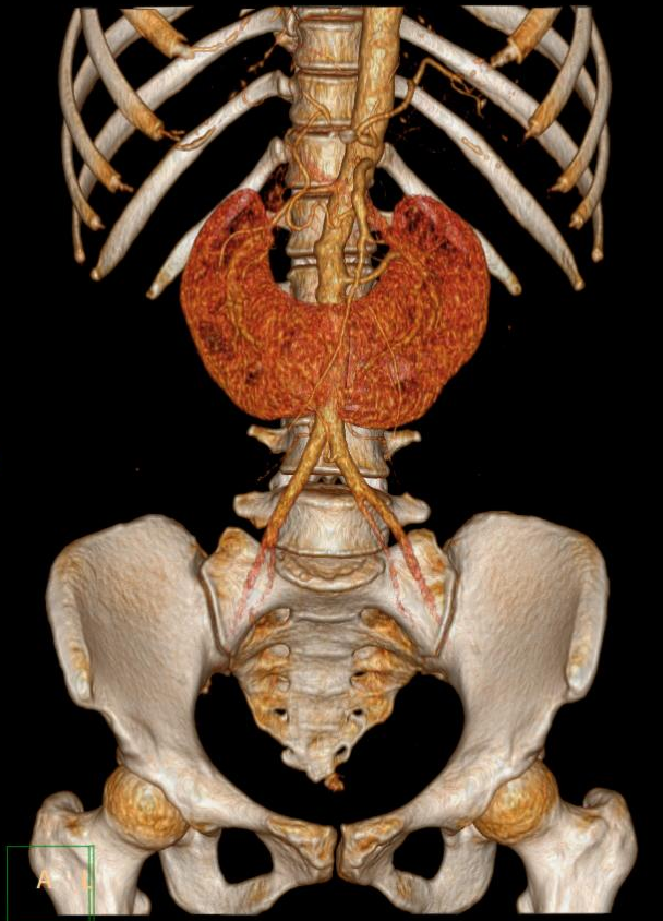 Horseshoe kidney | Image | Radiopaedia.org