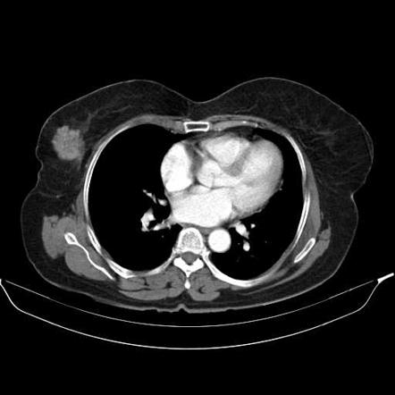 Invasive ductal breast carcinoma on CT