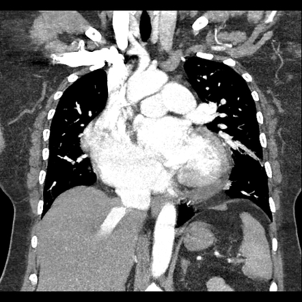 Scimitar syndrome | Image | Radiopaedia.org