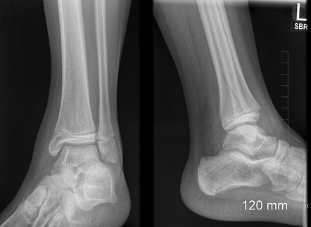 Salter-Harris Type II Distal Tibia Fracture | Radiology Case ...