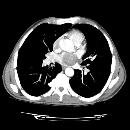 Lung cancer invading the left atrium | Radiology Case | Radiopaedia.org