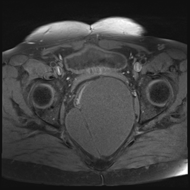 Tailgut duplication cyst | Image | Radiopaedia.org