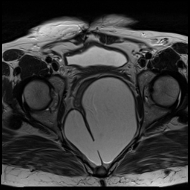 Tailgut duplication cyst | Image | Radiopaedia.org