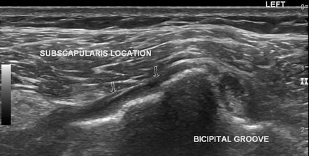 Subscapularis tendon tear | Radiology Case | Radiopaedia.org