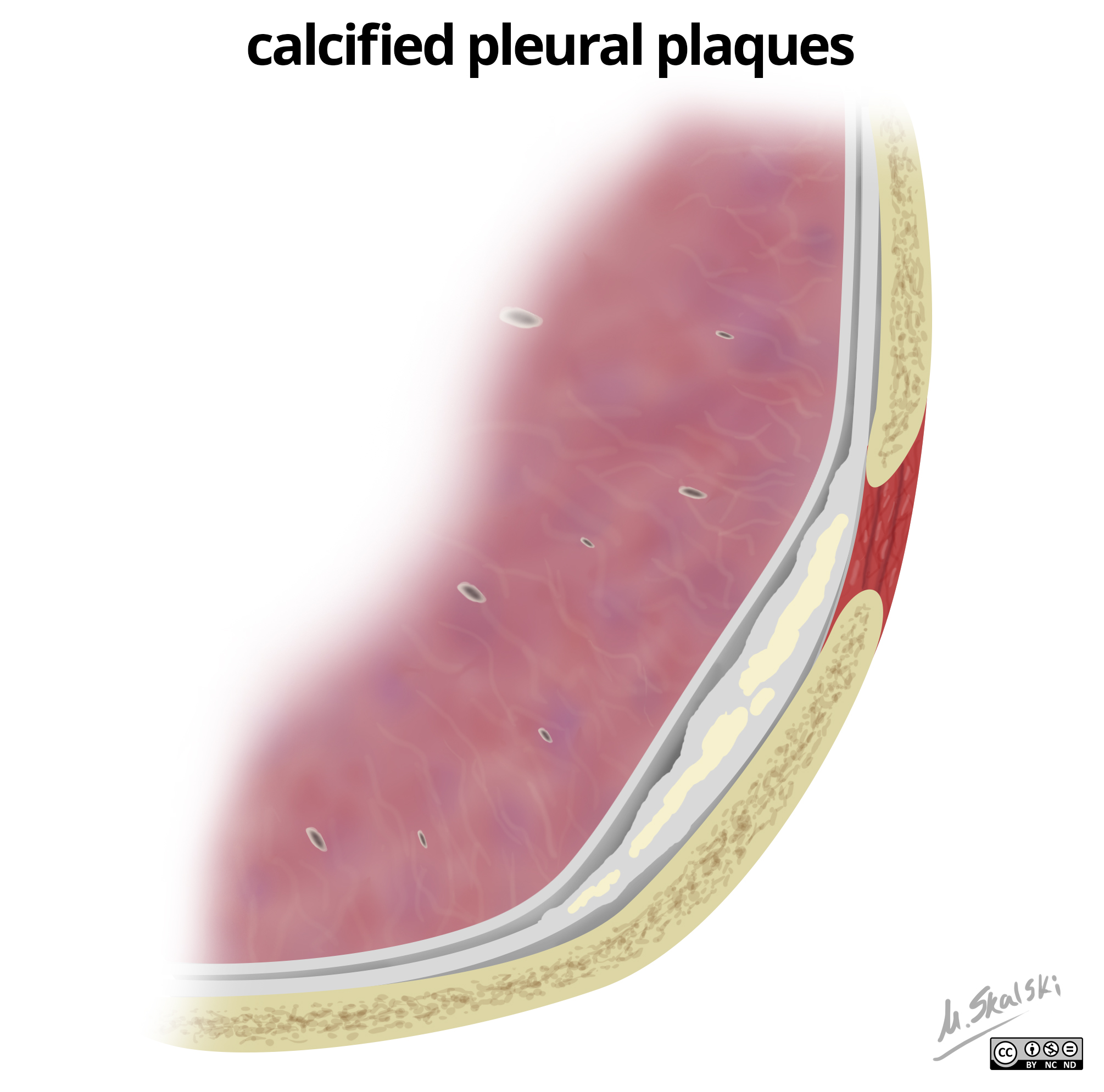 Pleural thickening: illustrations | Image | Radiopaedia.org