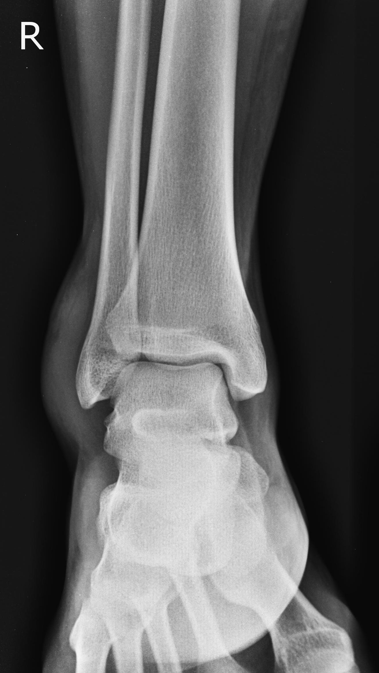 Anterior Talofibular Ligament Injury | Image | Radiopaedia.org