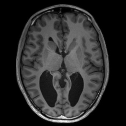 Callosal dysgenesis with interhemispheric cyst | Image | Radiopaedia.org