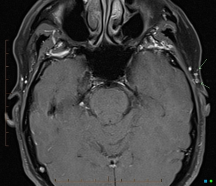 Giant cell arteritis | Image | Radiopaedia.org