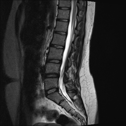 mid lumbar spine