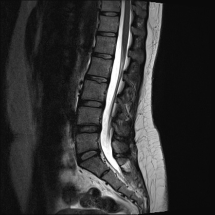 Lumbar Spine Mri Mri Scan Images Mri Mri Scan Lumbar Images