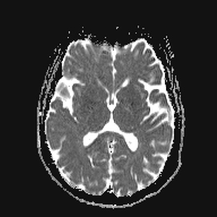 Clival meningioma | Image | Radiopaedia.org