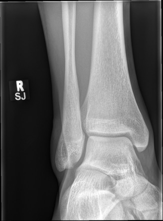 Isolated Posterior Malleolus Fracture 