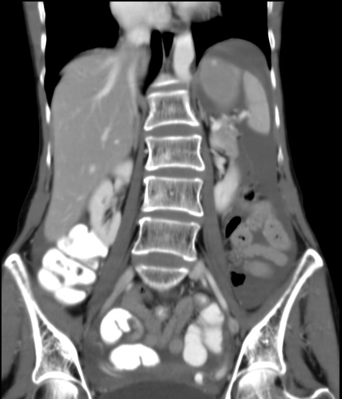 Splenic injury (grade III with active bleeding) | Image | Radiopaedia.org