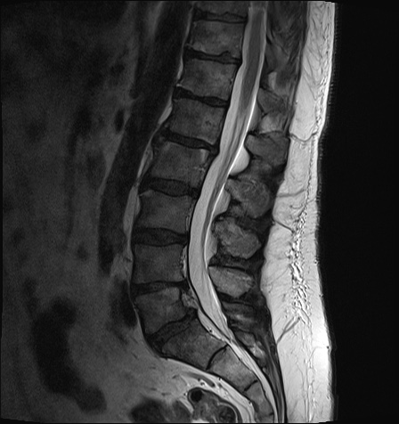 Pars defect | Image | Radiopaedia.org