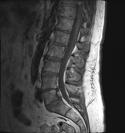 Pars defect | Image | Radiopaedia.org