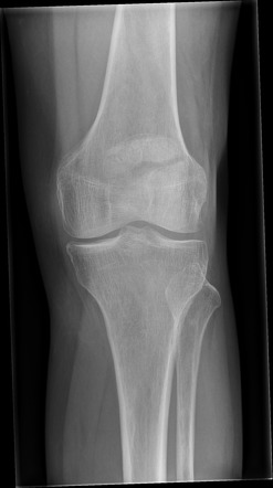 Patellar fracture | Radiology Case | Radiopaedia.org