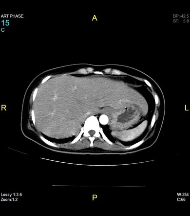 Pyogenic Liver Abscess Complicated By Septic Pulmonary Emboli | Image ...