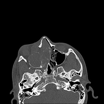 Sinonasal undifferentiated carcinoma | Image | Radiopaedia.org