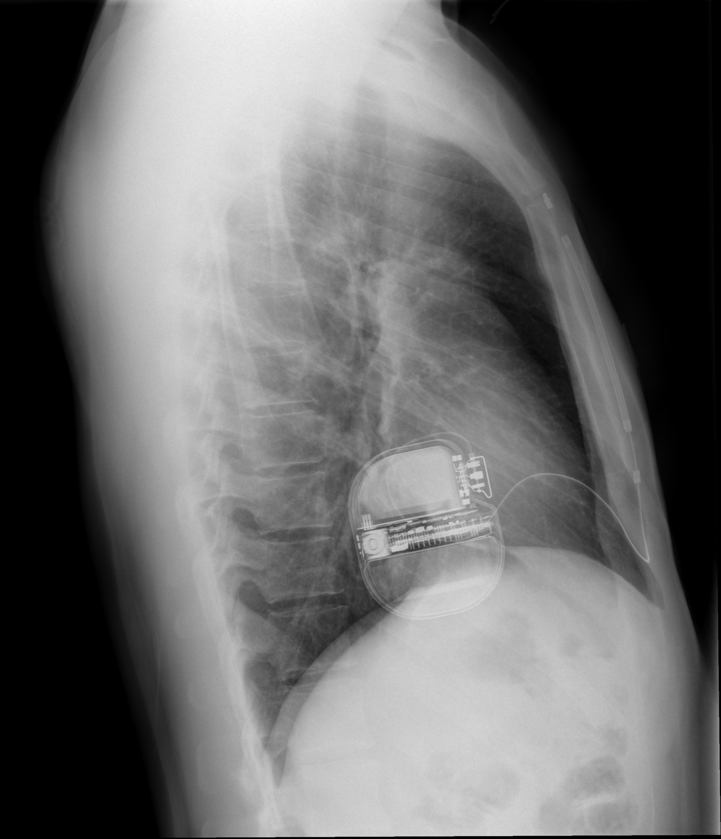 Subcutaneous Implantable Cardioverter Defibrillator Image