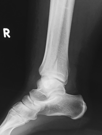 Undisplaced Lateral Malleolar Fracture 