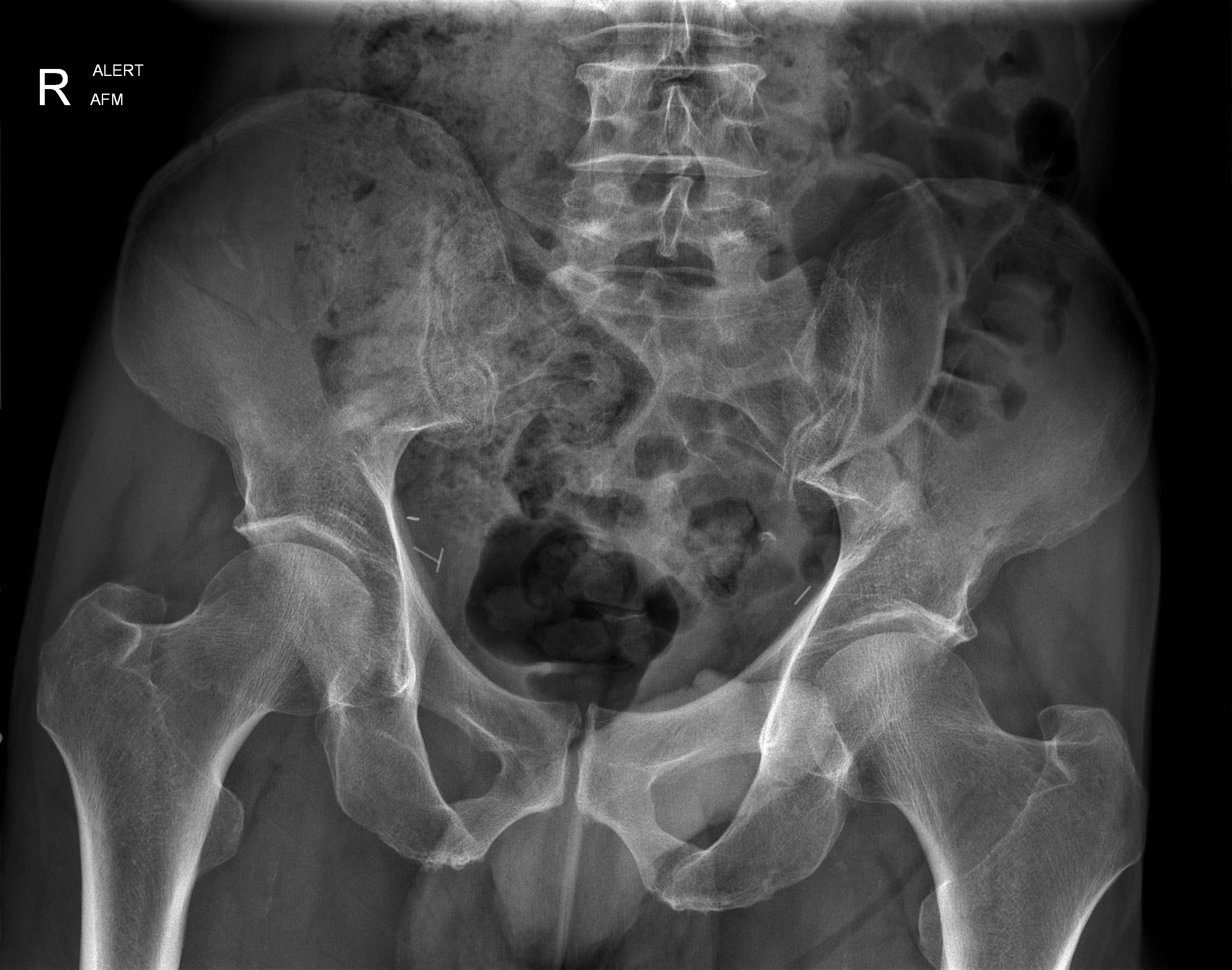 right-iliac-wing-fracture-image-radiopaedia