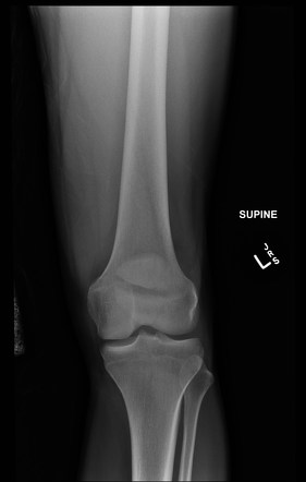 Patella Fracture Radiology Case Radiopaedia Org