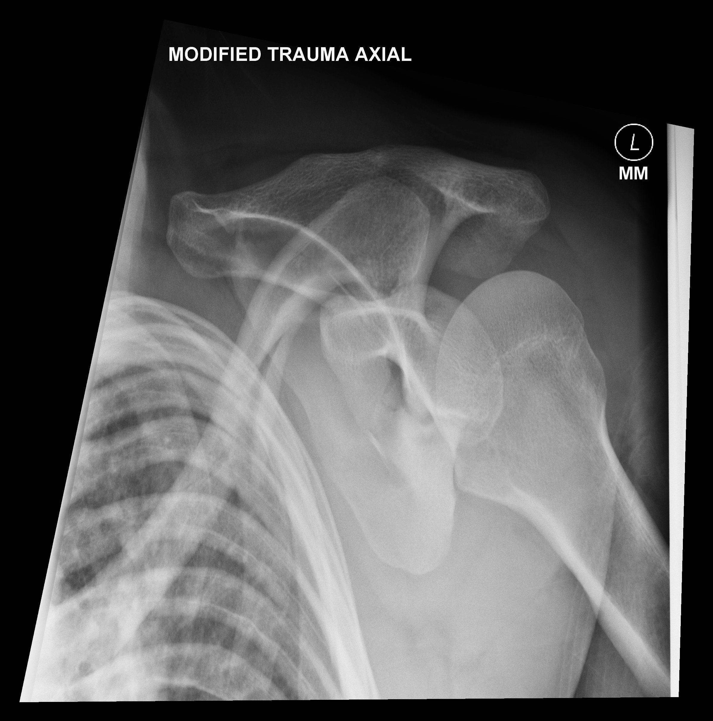 Clavicle and scapula fractures Image