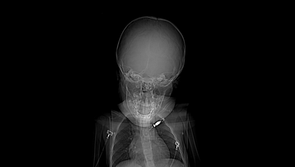 TASER injury to eye Image