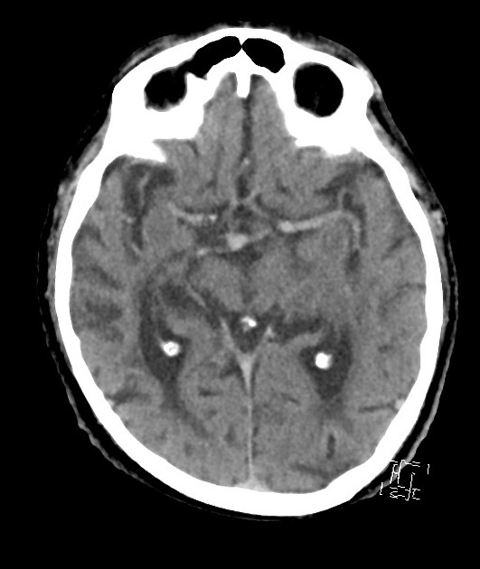 Hyperdense MCA sign (brain)  Radiology Reference Article