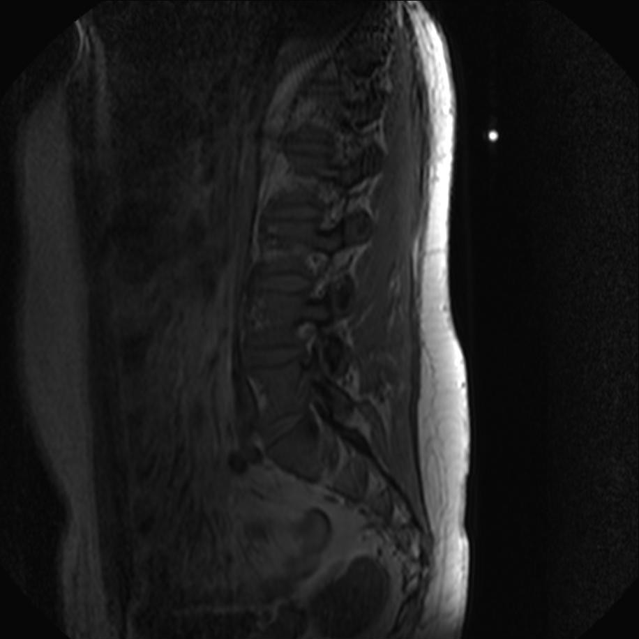 Disc extrusion | Image | Radiopaedia.org