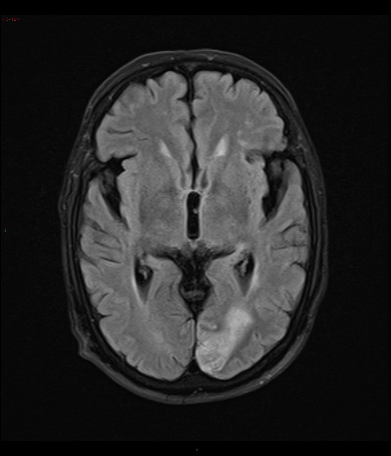 Left posterior cerebral artery territory infarct | Image | Radiopaedia.org