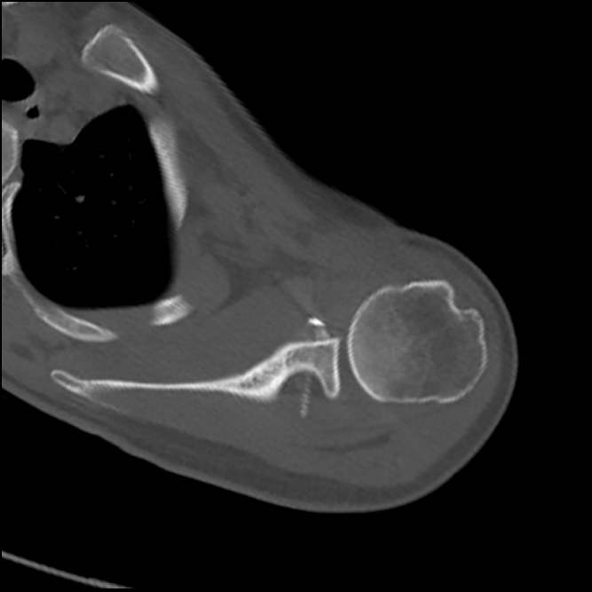 Latarjet Arthrex Naples Modified Arthroscopic Latarjet Procedure With ...