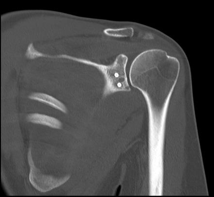 Unsatisfactory Latarjet procedure | Image | Radiopaedia.org