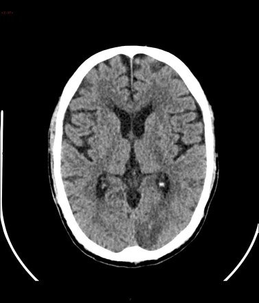 Left posterior cerebral artery territory infarct | Radiology Case ...