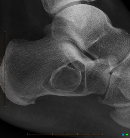 Calcaneal lipoma | Radiology Case | Radiopaedia.org