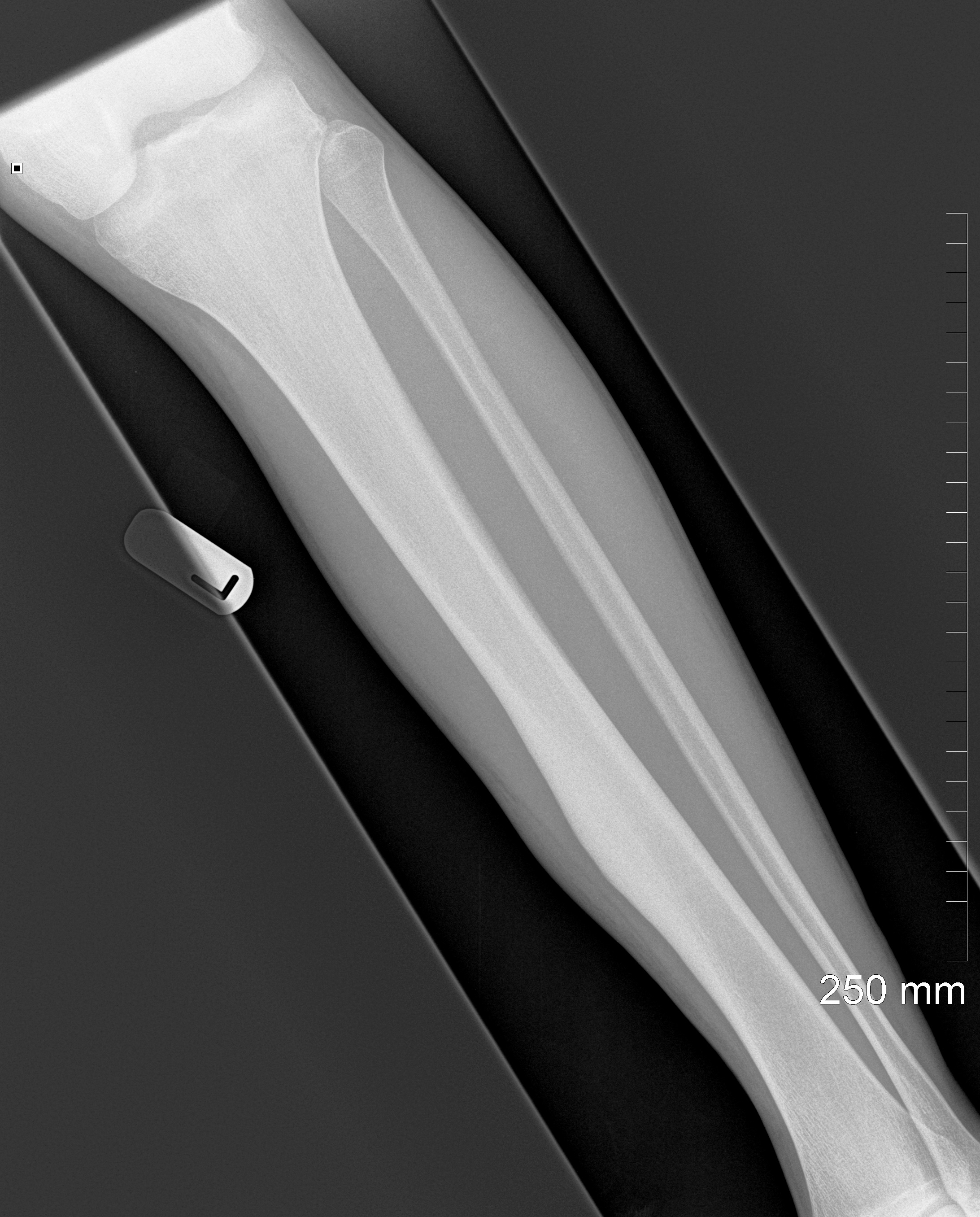 Osteoid Osteoma | Image | Radiopaedia.org