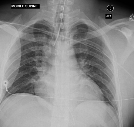 Malpositioned nasogastric tube | Radiology Case | Radiopaedia.org