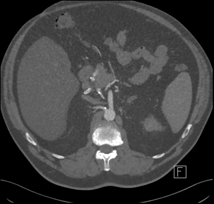 Median Arcuate Ligament Syndrome Image