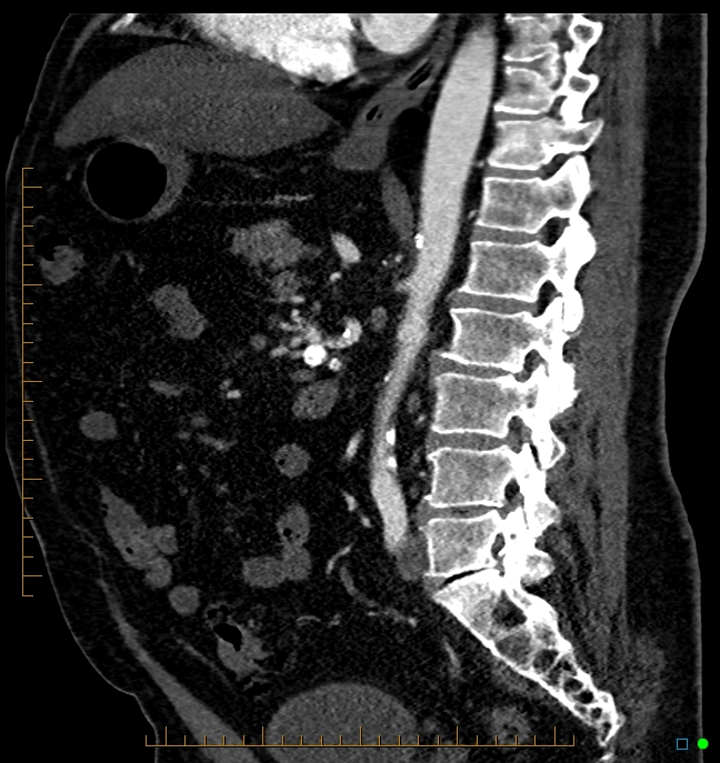 Median Arcuate Ligament Syndrome Image