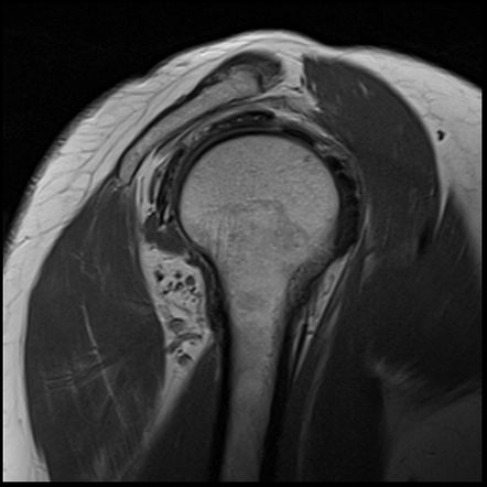 Quadrangular space syndrome | Image | Radiopaedia.org