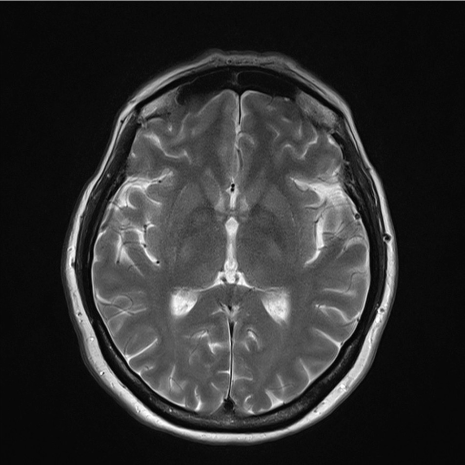 Central Base Of Skull Meningioma Image