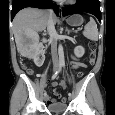 Retroperitoneal sarcoma presenting as a right-sided varicocele | Image ...