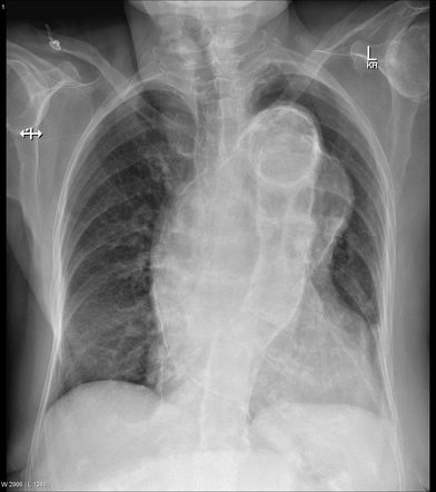 Thoracic aortic aneurysm | Radiology Reference Article | Radiopaedia.org