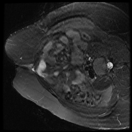 Umbilical endometriosis | Image | Radiopaedia.org