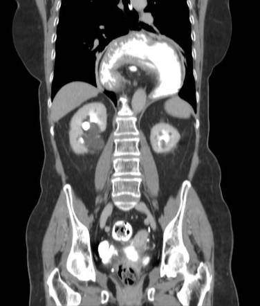 Paraesophageal hernia, stomach in organoaxial position | Radiology Case ...