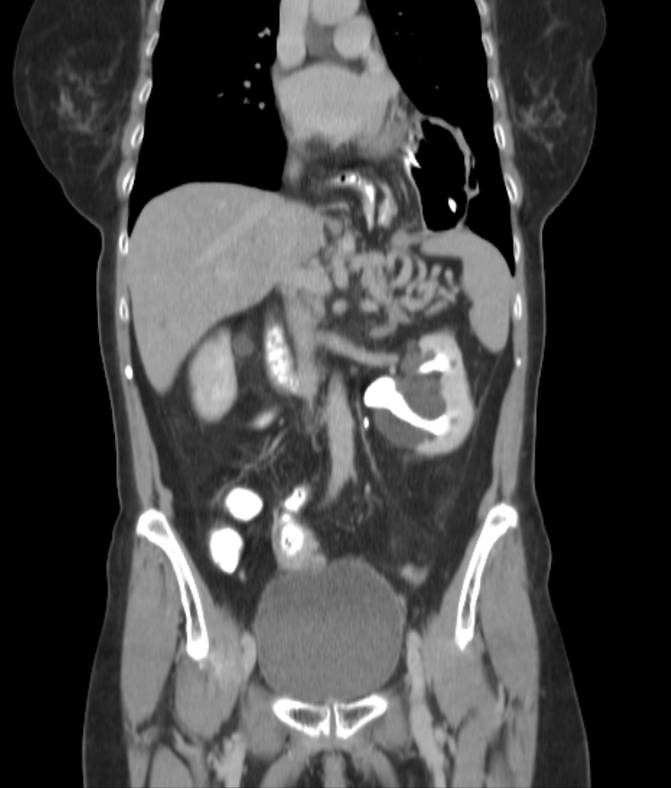 File:Paraesophageal hernia, stomach in organoaxial position ...